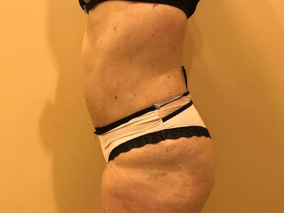 Before & After Patient