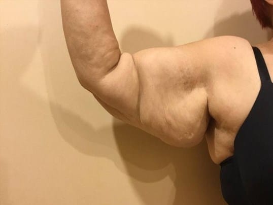 Before & After Arm Lift Patient