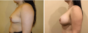 Before & After Patient