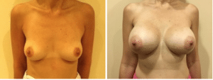 Before & After Patient
