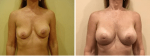 Before & After Patient
