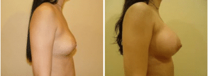 Before & After Patient
