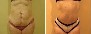 Before & After Patient