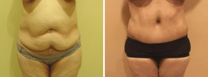 Before & After Patient