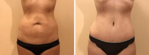 Before & After Patient