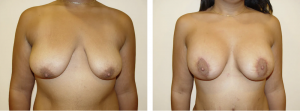 Before & After Patient
