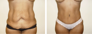 Before & After Patient