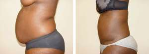 Before & After Patient