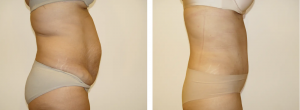 Before & After Patient