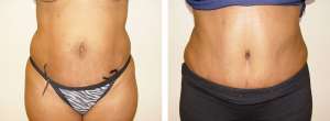 Before & After Patient