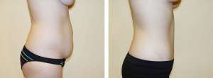 Before & After Patient