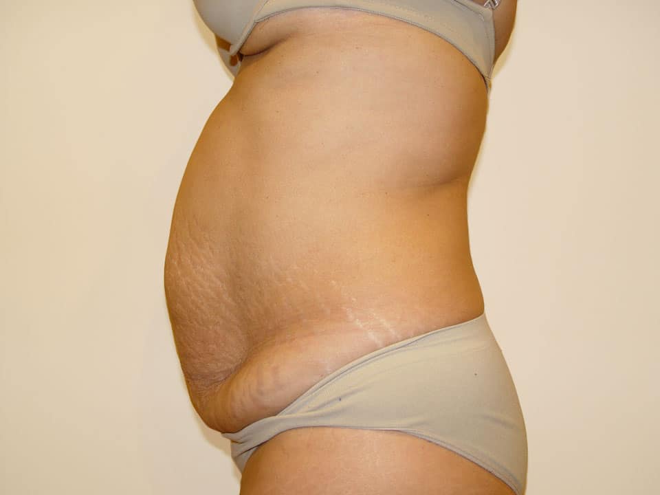Before & After Patient