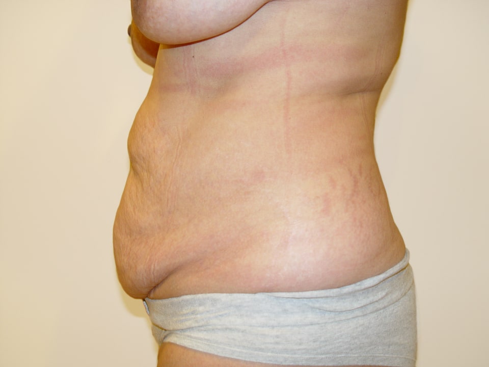Before & After Patient