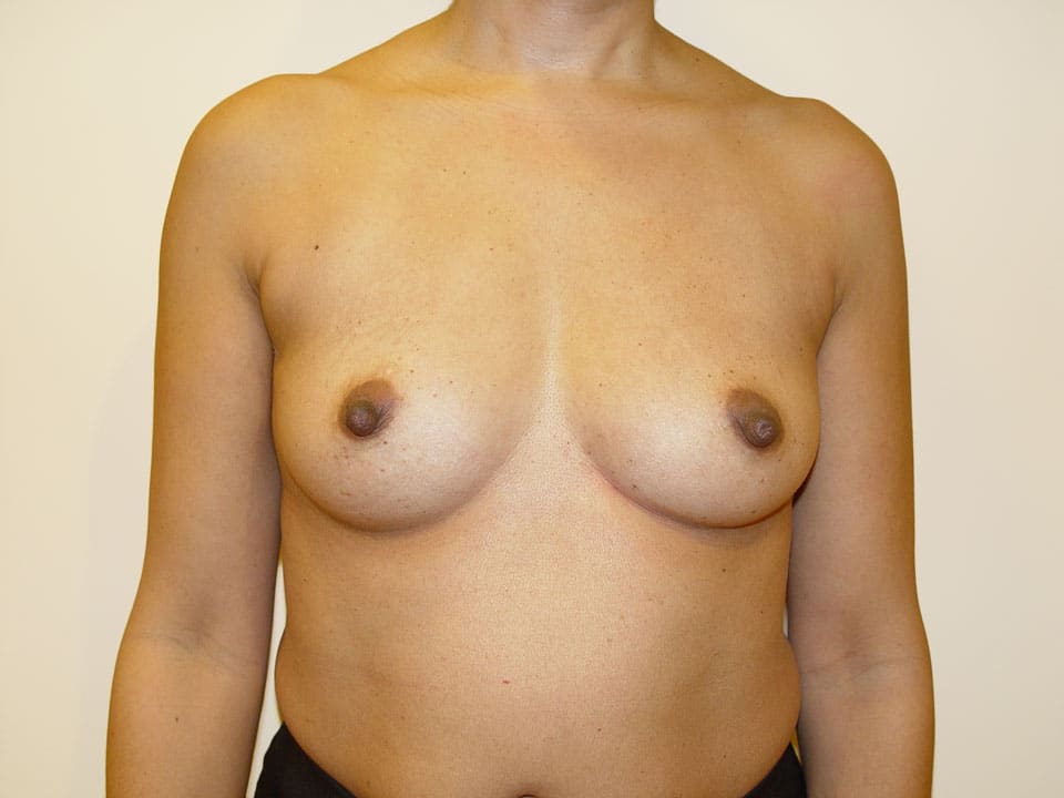 Before & After Patient