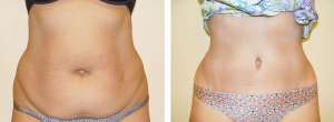 Before & After Patient