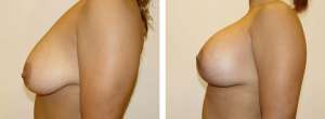 Before & After Patient