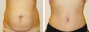 Before & After Patient