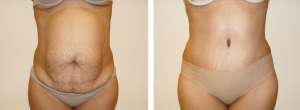 Before & After Patient