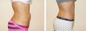 Before & After Patient