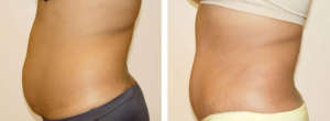 Before & After Patient