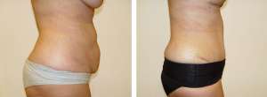 Before & After Patient