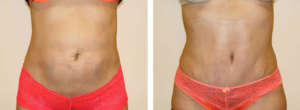 Before & After Patient