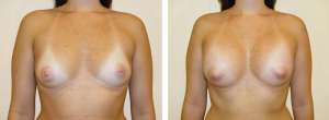 Before & After Patient