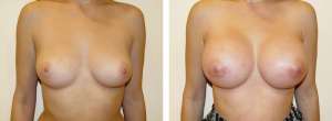 Before & After Patient