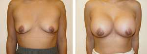 Before & After Patient