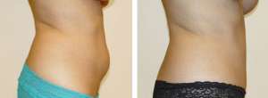Before & After Patient