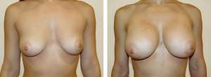 Before & After Patient