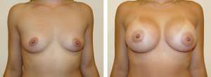 Before & After Patient