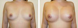 Before & After Patient
