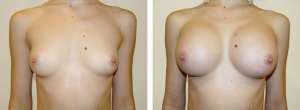 Before & After Patient
