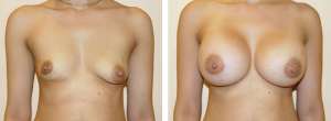 Before & After Patient