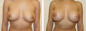 Before & After Patient