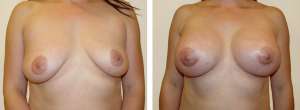 Before & After Patient