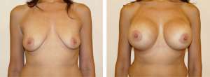 Before & After Patient