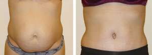 Before & After Patient