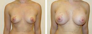 Before & After Patient