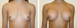 Before & After Patient