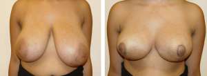 Before & After Patient