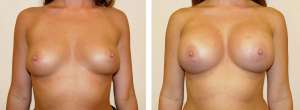 Before & After Patient