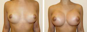 Before & After Patient