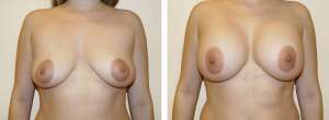 Before & After Patient