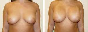 Before & After Patient