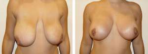 Before & After Patient
