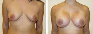 Before & After Patient