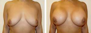 Before & After Patient