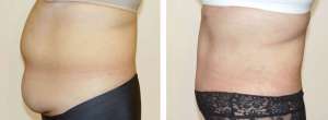Before & After Patient